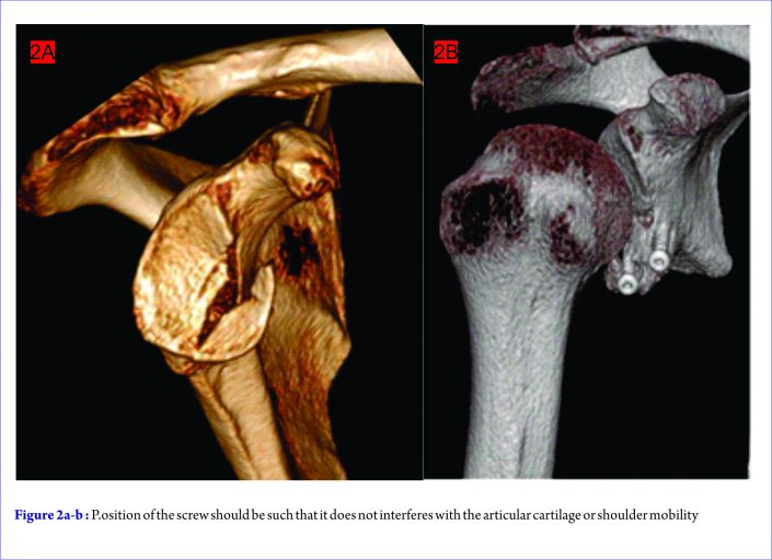 Arthroscopic treatment of Glenoid Fractures - Acta of Shoulder and ...